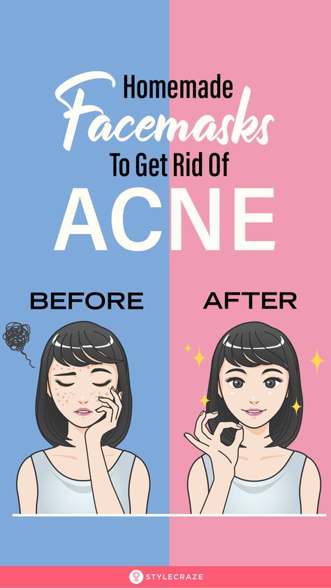 Pimple Free Skin, Homemade Face Pack, Forehead Acne, Acne Free Skin, Acne Skincare, Diy Acne, Get Rid Of Acne, Rid Of Acne, Natural Acne Remedies