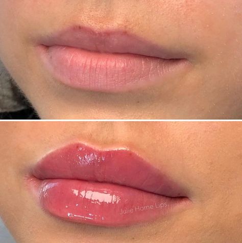 Lip Filler Reference Photos, Natural Russian Lips, Natural Looking Lip Injections, .5ml Lip Filler, Lip Fillers Natural Look, Lip Filler Lips, Julie Horne Lip Filler, Lip Botox Natural, Kysse Lips Filler