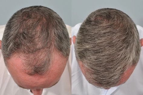 Hair Transplant Cost, Hair Transplant Results, Hair Transplant Procedure, Fue Hair Transplant, Hair Transplant Surgery, Best Hair Transplant, Male Pattern Baldness, Pattern Baldness, Lost Hair