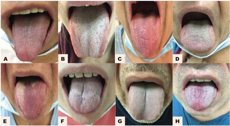 Breakthrough AI detects diseases with 98% accuracy via tongue scans - The Brighter Side of News Tongue Color Meaning, Human Tongue, University Of South Australia, Zinc Supplements, Color Meanings, Medical News, Traditional Chinese Medicine, Disease, Medical