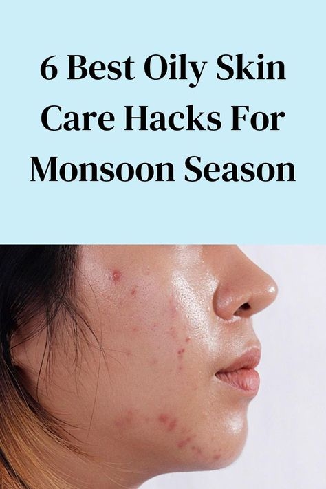 Skin Care Hacks, Greasy Face, Summer Skin Care Tips, Oily Skin Remedy, Oily Skin Care Routine, Monsoon Season, Acne Skincare Routine, Night Skin Care Routine, Winter Skin Care