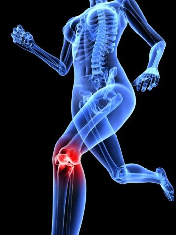 http://www.aurawellnesscenter.com/2014/02/21/how-to-protect-the-knees-in-yoga-classes/ Patellofemoral Pain Syndrome Exercises, Patellofemoral Pain Syndrome, Knee Pain Exercises, Orthopedic Surgeon, Yoga Anatomy, Nerve Pain Relief, Knee Exercises, Knee Pain Relief, Knee Replacement