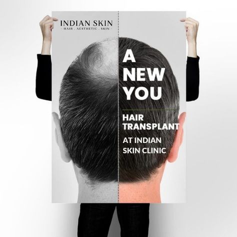 Be bald free in a matter of hours with the best techniques in hair transplant. For more info contact:9373866545 #drayeshafaizan #indianskin#hairtransplant #hairloss #fue #sa #hairtransplantation #hair #ekimi #hairrestoration #hairtransplant #hairloss #fue #scalpmicropigmentation #plasticsurgery #hairclinic #implantecapilar #bhfyp #bhfyp Hair Transplant Ads, Dermatologist Skin Care, Hair Grower, Hair Poster, Skin Care Center, Skin Care Business, Scalp Micropigmentation, Cosmetic Clinic, Types Of Skin