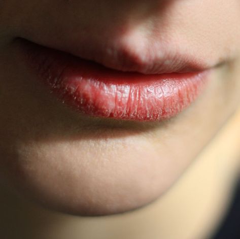 12 Chapped Lips Causes And How To Treat Them, According To Dermatologists Modern Mediterranean Bedroom, Lip Lickers, Mediterranean Style Bedroom, Dry Scaly Skin, Lips Peeling, Dehydrated Lips, Mediterranean Bedroom, Dry Cracked Lips, Relaxation Station