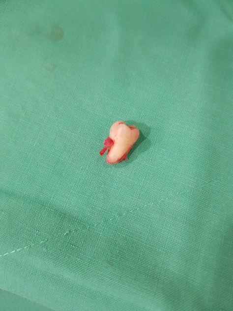 Wisdom tooth extraction. Next one is Monday. Wishes Board, Tooth Implant, Tooth Extraction Healing, Wisdom Tooth Extraction, Wisdom Tooth, Dry Socket, Teeth Implants, Tooth Extraction, Wisdom Teeth