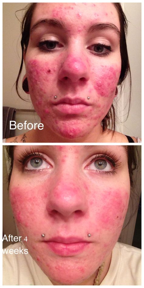 Before & After Doxycycline. Also, no depo provera. I think depo had a lot to do with why my face got so bad. I never had acne until I started getting the shots. #skin #acne #doxycycline #depoprovera Depo Provera, Acne Medicine, Bad Acne, Almost Perfect, Healthy Habits, Cocktail Recipes, The Truth, Moisturizer, Acne