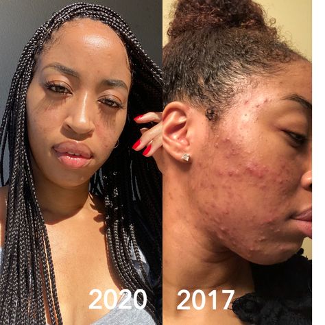 Clearing my acne, Im sharing my practical tips to clear your skin and 5 Things You Should Not Do If You Have Acne/Problematic Skin with my 5 Tips for Dealing with Acne and all the products I am currently using #blackskincare #clearskin #acne #skincaretransformation #howtoclearskin Acne Journey, Clear Your Skin, Acne Diet, Jennifer Miller, Bad Acne, Black Skin Care, Cystic Acne, Clear Acne, Increase Engagement