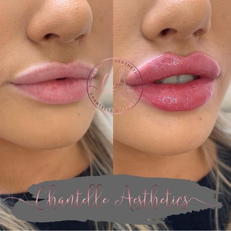 DETAILS BELOW: .📍 Manchester, UK 🇬🇧 .✖️ Chantelle Aesthetics . 👩🏼‍⚕️ Nurse . 📷 @chantelleaesthetics . . #lips #dermalfiller #filler… Aesthetics Nurse, Dermal Fillers Lips, Lips Inspiration, Botox Lips, Kylie Jenner Lips, Facial Fillers, Gel Toe Nails, Injectables Fillers, Facial Aesthetics