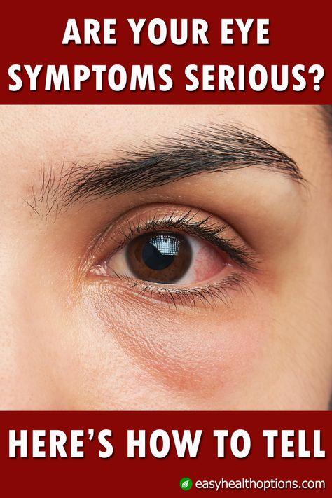 We all have times when our eyes are red, itchy or irritated. But how can you tell whether a color, swelling or other sensation is commonplace and nothing to worry about, or something you should get attention for immediately? Eye Irritation Remedies, Itchy Eyes Remedy, Red Eyes Remedy, What Causes Red Eyes, Itchy Eyelids, Swelling Remedies, Swollen Eyes, Irritated Eye, Eye Infections