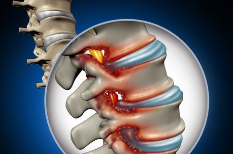 Stenosis Exercises, Spinal Fusion, Disk Herniation, Spinal Nerve, Spinal Injury, Spine Surgery, Muscle Weakness, Sciatic Nerve Pain, Sciatica Pain