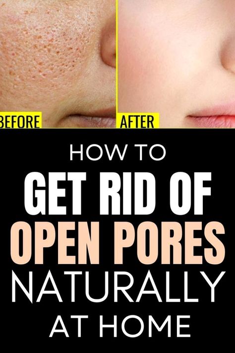 Open Pores On Face, Pores On Face, Big Pores, Oily Skin Remedy, Nose Pores, Face Pores, Pore Mask, Open Pores, Smaller Pores