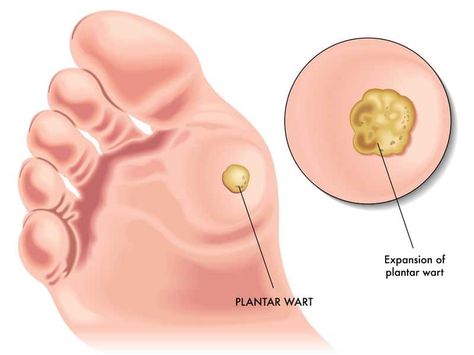 How To Use Essential Oils For The Best Possible Elimination Of Warts? Essential Oil Benefits Plantar Wart Removal, Planters Wart, Get Rid Of Corns, Plantar Warts, Types Of Warts, Facial Warts, Warts On Hands, Warts On Face, Warts Remedy