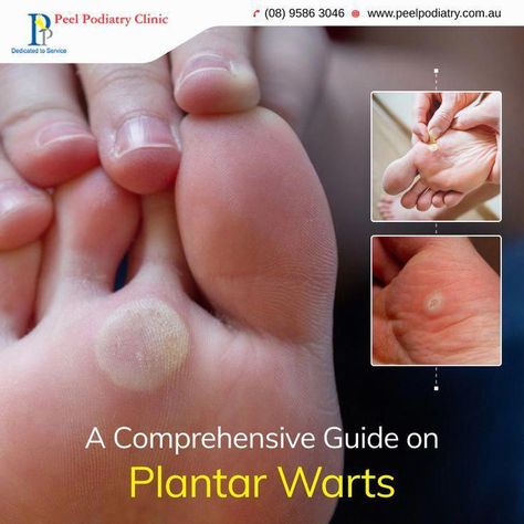 Seed Wart, Plantar Wart Removal, Planters Wart, Human Papilloma Virus, Podiatry Clinic, Plantar Warts, Types Of Warts, Home Remedies For Warts, Warts Remedy