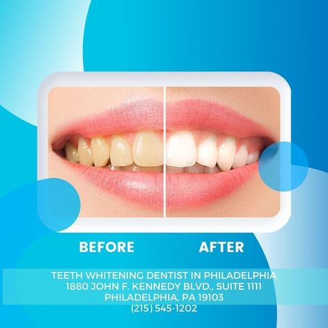 If you live in Philadelphia, you can benefit from a teeth whitening procedure at our dental office. We are known for improving the appearance of our patients' smiles. To make an appointment contact us (215) 545-1202. //dentist//dental//dentistry// #philadelphia #teethwhitening Dentist Social Media, Dental Mouthguards, Teeth Whitening Dentist, Dental Doctor, Dental Social Media, Teeth Whitening Procedure, Dental Posts, Best Dental Implants, Dental Design