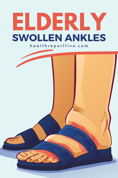 Swollen feet, vector illustration Joints Pain Remedy, Natural Remedies For Migraines, Swollen Ankles, Swollen Legs, Dry Skin Remedies, Nerve Pain Relief, Relieve Back Pain, Cold Home Remedies, Cold Sore