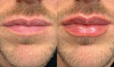 Serge A. Steenen, MD DDS (@dr_steenen) posted on Instagram: “Male lips by doctor Serge A. Steenen, MD DDS . 🇳🇱 . #masculine #masculinity #malemodel #man #lipfillers #lip #lips #beauty #faceland…” • Mar 13, 2020 at 5:21pm UTC Mens Lip Filler, Mens Lips, Man Lips, Men Lips, Male Lips, Filler Ideas, Botox Lips, Female Lips, People Reference