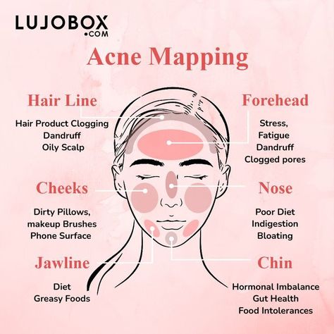 Here's a Face Map that might helpIf you are noticing concentrated breakouts on your facethere's a strong reason something is causing itKnowing the cause will help make the needed changes to control acne more effectively and avoid them in the futureacnemapping acnetreatment causeofacne acnepositivity acneawareness acne pimples blackheads skincare skincaretips skincareaddict skincare loveyourself confidence monthlysubscription beautybox lujobox lujoboxbeauty Reasons For Pimples, Face Map, Acne Reasons, Pimple Causes, Blind Pimple, Pimples Under The Skin, Pimples On Face, Face Mapping, Natural Acne Remedies