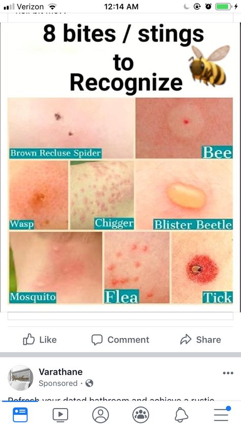 First Aid Tips, Mosquito Bites, Survival Skills Life Hacks, Survival Life Hacks, Bug Bites, Survival Life, Medical Knowledge, Simple Life Hacks, Diy Life Hacks