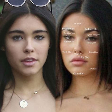 Madison Beer plastic surgery surgery before and after, natural face without makeup and surgery. 2020,2021,2022,2023 plastic surgery analysis breakdown Eyebrow Lift Surgery, Botox Lip Flip, Filler Face, Eye Lift Surgery, Foxy Eye, Lip Flip, Lip Surgery, Cheek Implants, Chin Filler