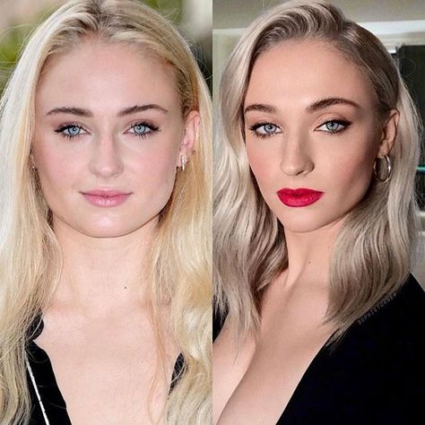 Winter is here and looking better than ever ❄️👑 Sophie Turner from Game of Thrones looking amazing after what appears to be cheek, chin and… Botox Jaw, Face Plastic Surgery, Square Jawline, Good Jawline, Botox Before And After, Face Fillers, Face Surgery, Jaw Surgery, Botox Cosmetic