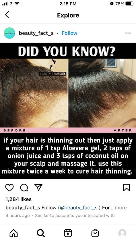 Women Hair Loss Hair Growth Medicine, Homemade Hair Treatments, Hair Care Remedies, Natural Skin Care Remedies, Natural Face Skin Care, Hair Growing Tips, Good Skin Tips, Beauty Tips For Glowing Skin, Homemade Hair Products