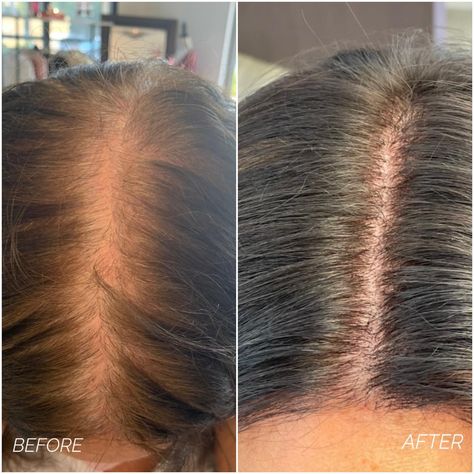 Check out Jody’s Testimonial! Swipe through to see her results and video! #hair #bayarea #balding #hairrrstoration #results #yay #salon #testimonial #success Hair Filler, Hair Content, V Hair, Hair Growth Secrets, Morgan Hill, Aesthetic Medicine, Hair Restoration, Hair Growth, Medicine