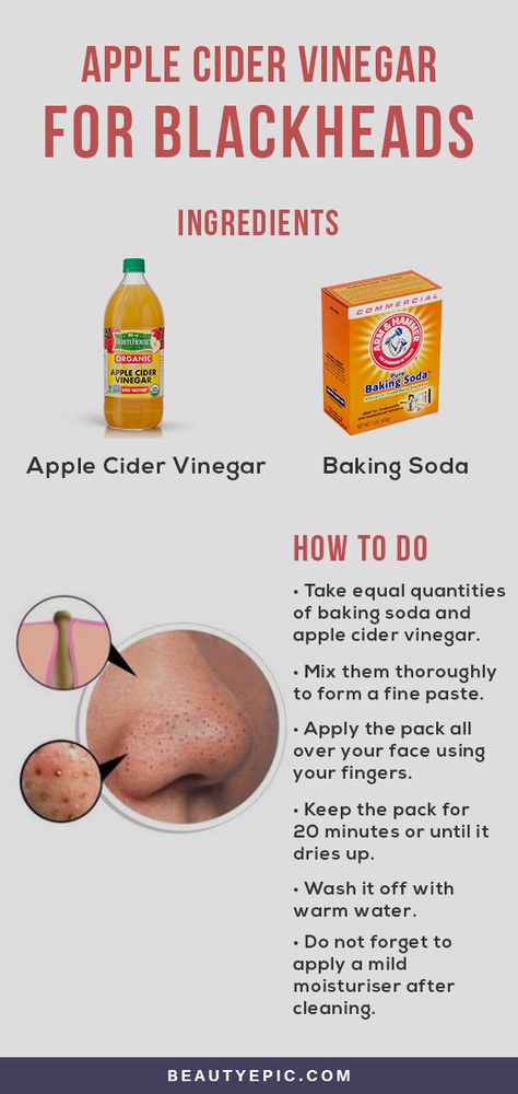 Can Apple Cider Vinegar Help You Get Rid Of Blackheads? For Blackheads, Rid Of Blackheads, Apple Vinegar, Canned Apples, Organic Apple Cider, Get Rid Of Blackheads, Blackhead Remover, Cider Vinegar, Apple Cider Vinegar