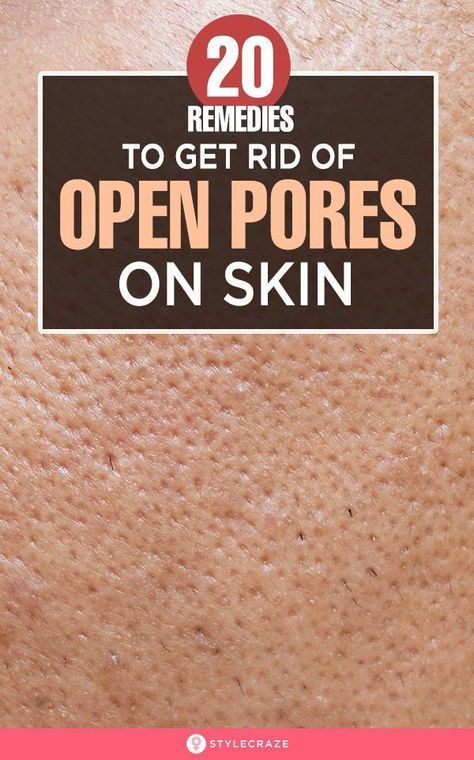 Open Pores On Face, Pores On Face, Lotion For Oily Skin, Home Remedies For Skin, Open Pores, Baking Soda Shampoo, Moisturizer For Oily Skin, Large Pores, Skin Pores