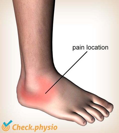 Lateral ankle ligament injury | Physio Check Ankle Problems, Ankle Injuries, Wrap Ankle Injury, Ankle Tendons And Ligaments, Exercise With Ankle Injury, Strapping Ankle Injury, Deltoid Ligament Ankle, Tendon Vs Ligament, Torn Ligament In Ankle