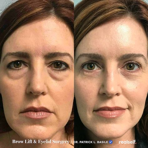 A brow lift, also known as a forehead lift, is a surgical procedure that raises the skin of the forehead to lift a sagging brow and smooth forehead lines and wrinkles. Hooded Eye Surgery, Eye Bag Surgery, Eye Lift Surgery, Endoscopic Brow Lift, Brow Lift Surgery, Neck Lift Surgery, Botox Brow Lift, Forehead Lift, Forehead Lines