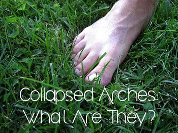 Collapsed Arches: What Are They? - 30 Something Mother Runner Plantars Wart Remedy, Planters Warts On Foot, Planter Warts Remedies, Planters Wart, Plantar Warts, Warts Remedy, 30 Something, Fallen Arches, Mother Runner