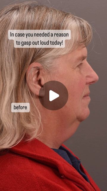 Quatela Center for Plastic Surgery on Instagram: "There is no caption that could speak louder than these images! This is LIFE CHANGING!  Surgery: facelift with deep neck work, temporal lift, upper and lower eyelid lift  Surgeon: World Renowned Double Board Certified Facial Plastic Surgeon Dr. Vito Quatela   #facelift #faceliftsurgery #faceliftspecialist #faceliftexpert #faceliftbeforeandafter #deepplanefacelift #naturalfacelift #lifechanging #plasticsurgery #plasticsurgeon" Plastic Surgery Before And After Face, Upper Eyelid Lift Surgery, Eyelid Lift Surgery Before After, Neck Lift Before And After, Lower Face Lift Before And After, Plastic Surgery Before And After, Lip Lift Surgery, Plastic Surgery Fails, Double Chin Surgery