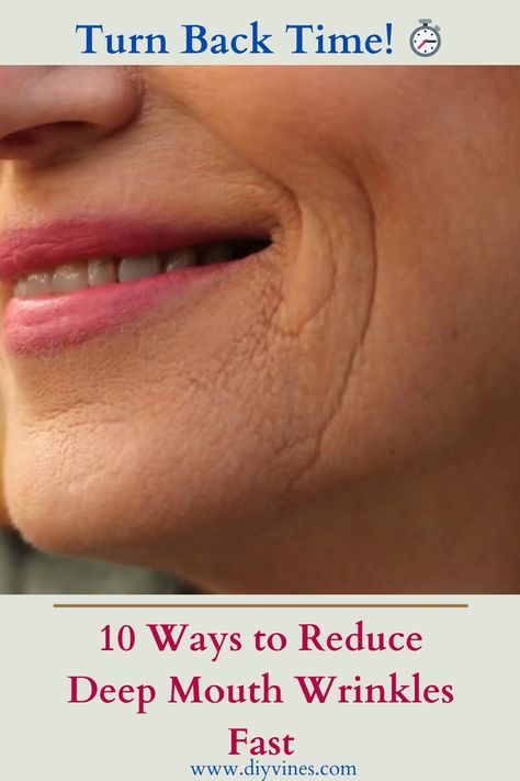 10 Ways to Reduce Deep Mouth Wrinkles Fast Deep Wrinkles Around Mouth, How To Get Rid Of Frown Lines By Mouth, Dry Mouth Remedies How To Get Rid, Frown Lines Around Mouth, Wrinkles Around Mouth, Lines Around Mouth, Upper Lip Wrinkles, Cheek Wrinkles, Smile Wrinkles