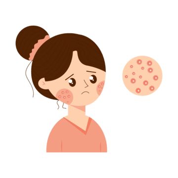 Acne Animation, Skin Care Cartoon, Acne Images, Acne Drawing, Acne Illustration, Skincare Graphics, Skincare Icon, Jawline Acne, Acne Women