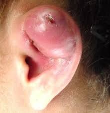 piercing infection - Google Search Infected Cartilage Piercing, Boil Popping Videos, Nose Piercing Infection, Cartilage Piercing Infection, Skin Boil, Ear Pimple, Piercing Bump, Graphic Video, Ear Parts