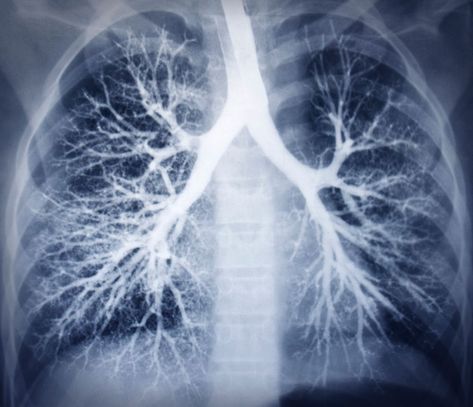 What is COPD? How to build health to help? https://www.mcvitamins.com/copd-lungs.htm #lungs #pulmonary #breathe #airflow Human Respiratory System, Lung Conditions, Healthy Lungs, Pulmonary Disease, Lung Disease, Respiratory System, Lungs, Blood Vessels, Respiratory