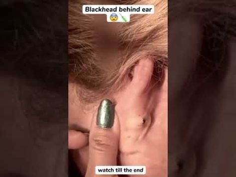 Blackhead Behind Ear #oddlysatisfying #sick #blackhead #pimplepopper #satisfying #cyst #wow #acne Blackheads Removal Cream, Closed Comedones, Ear Pimple, Big Pimple, Cystic Pimple, Cystic Acne Remedies, Dilated Pores, Blackhead Remover Diy, Clear Skin Routine