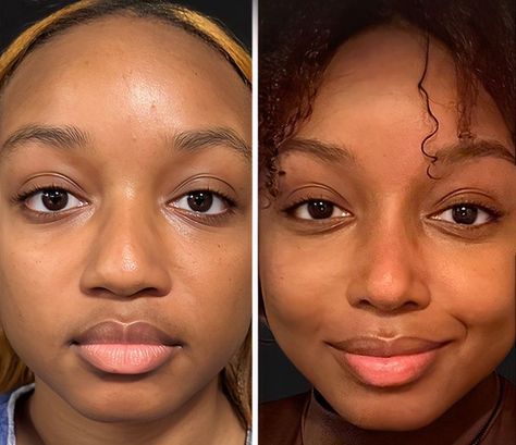 The Cosmetic Lane on X: "Rhinoplasty 👃🏾✨ The idea of an ethnic rhinoplasty is to preserve as much ethnicity as possible while attempting to address concerns patients have with their noses. https://t.co/eeaVvzxVz8" / X Lower Blephoraplasty Before And After, Bulbous Nose Rhinoplasty Before After, Wide Nose Rhinoplasty, Possessed Makeup, Ethnic Nose Job, Korean Rhinoplasty, Bad Nose Jobs, Nose Rhinoplasty, Jaw Reduction Surgery