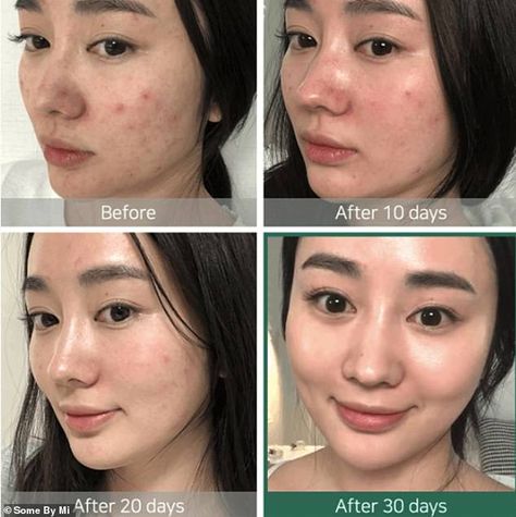 The Korean 'miracle' toner that has sold over 1.2 million units - and it gets rid of acne in 30 days | Daily Mail Online Miracle Toner, Skin Care Routine For 20s, Some By Mi, Aha Bha, Skin Toner, How To Get Rid Of Acne, Skin Food, Beauty Skincare, Glass Skin