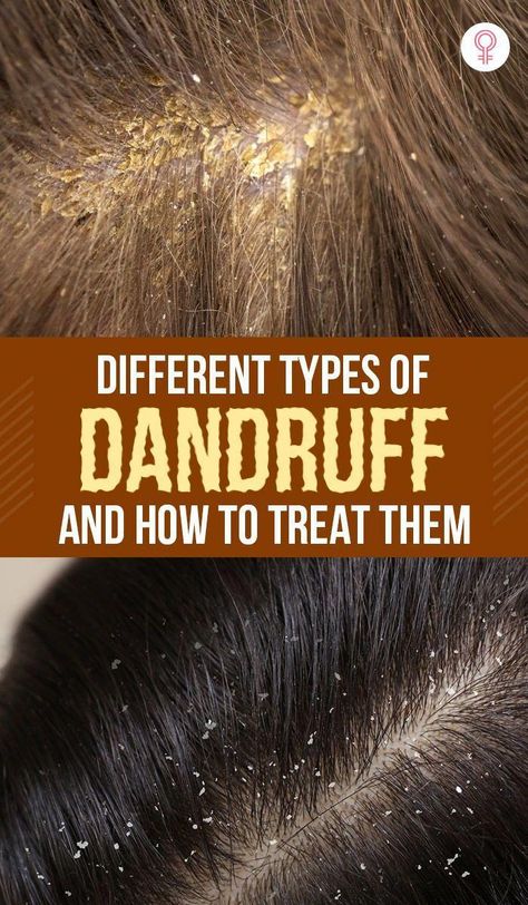 There are different types of dandruff. To effectively treat it and prevent future flakes, we Oils For Dandruff, Dandruff Remedy, Getting Rid Of Dandruff, How To Grow Your Hair Faster, Natural Acne Remedies, Baking Soda Shampoo, How To Grow Nails, Flexible Dieting, Long Hai