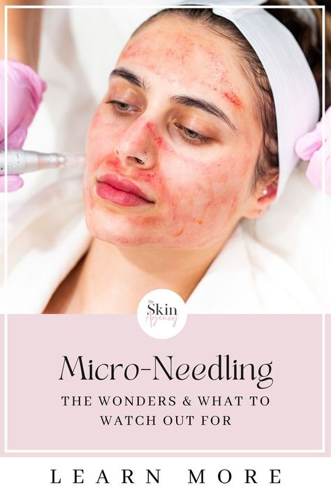 Unlock the Secret to Radiant Skin with Microneedling! Discover the amazing benefits of microneedling, from reducing wrinkles and acne scars to shrinking pores. Check out our before and after photos and learn what to expect with microneedling. Don't miss out on the opportunity to achieve flawless skin. Visit The Skin Agency today! Benefits Of Microneedling, Night Before Wedding, Laser Resurfacing, Age Gap, Shrink Pores, Skin Care Treatments, Girls Dpz, 25 Years Old, Flawless Skin