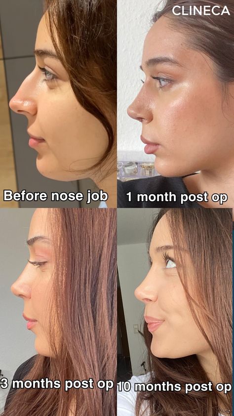 👃 1 Month: Swelling starts to go down, and the new shape is becoming more defined, but patience is key! You’ll notice changes daily.  💫 3 Months: Significant progress! Most of the swelling has subsided, and you’ll start seeing the final shape of your nose. Time to enjoy the results! 🌟  🌿 6 Months: Full healing and refinement of your nose's appearance. Your new look is here to stay! 🙌  Trust the process & enjoy your transformation! 💖 #NoseJob #Rhinoplasty #BeforeandAfter Celebrity Nose Jobs Before After, Side Profile Before And After, Rhinoplasty Results, Nose Job Results, Best Nose Shape, Finesse Rhinoplasty, Turkey Nose Job, Subtle Nose Job, Ideal Nose Rhinoplasty