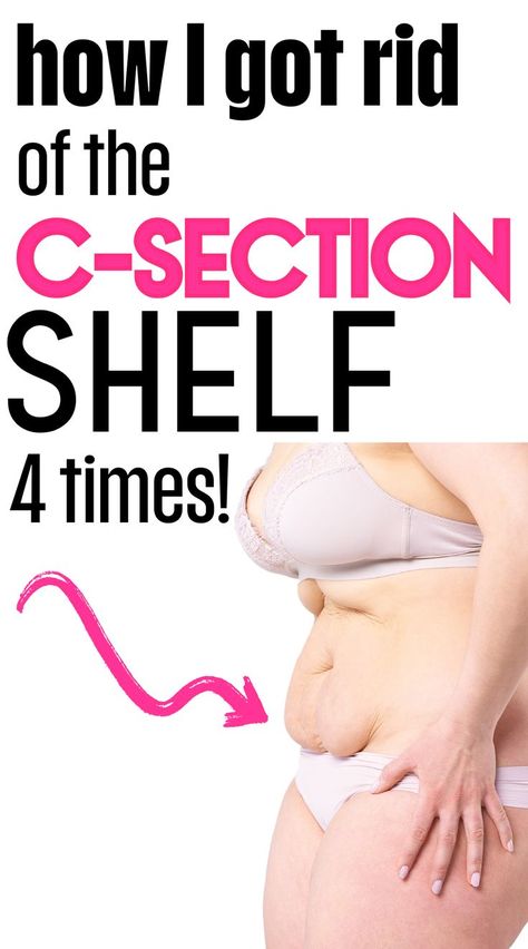 A new mom trying to lose her c-section shelf postpartum tummy with these postpartum workout tips. Shelf Workout, C Section Pouch, Postpartum Belly Workout, C Section Belly, After C Section Workout, Post C Section, C Section Workout, Belly Workouts, Postpartum Tummy