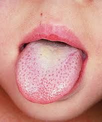 Ayurvedic Tongue Analysis: What does your tongue say about your health? - Svastha Ayurveda Yeast Infection Cream, Yeast Infection Medication, Yeast Infection Men, Chronic Yeast Infection, Candida Symptoms, Treat Yeast Infection, Candida Yeast Infection, Yeast Infection Causes, Yeast Infection Symptoms