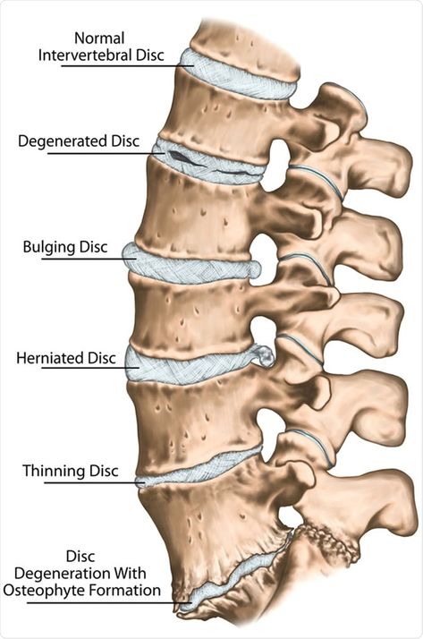 Spinal Degeneration, Lumbar Disc, Intervertebral Disc, Bulging Disc, Spinal Nerve, Degenerative Disease, Spine Health, Human Skeleton, Sciatic Nerve Pain