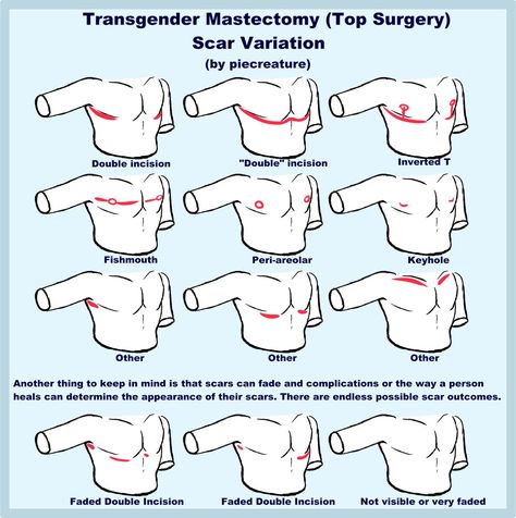 Sylar 🔪 on Twitter: "I usually see people giving their post op trans characters the same "standard" double incision scars. I thought I'd draw up some examples showing that there's tons of different outcomes a person can get from top surgery! They're actually tons of fun to mess around with!!… https://t.co/G1WPgvc7dI" Trans Characters Art, Trans Masc Top Surgery, Trans Dysphoria Drawing, Top Surgery Drawing, Demiboy Art, Trans Drawings Ftm, Trans Top Surgery, Top Surgery Art, Top Surgery Ftm