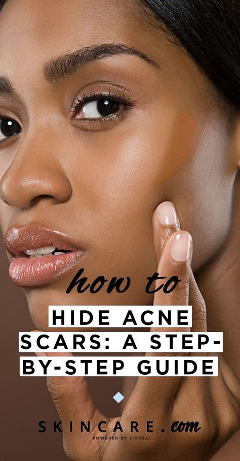 How To Hide Pimples, Cover Wrinkles, Acne Makeup, Pimple Scars, Bad Acne, Natural Acne Remedies, Skin Spots, Sharing Economy, Diy Remedies