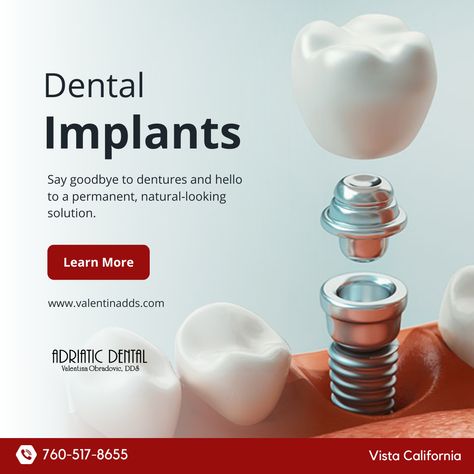 Dental implants look and feel like natural teeth. They are custom-made to match the color, shape, and size of the surrounding teeth, which can improve a person's smile and overall appearance. Call us ☎️ (760) 517-8655 Visit us at 👉🏼 https://buff.ly/3K3bArB #AdriaticDental #ValentinaObradovic #VistaDentist #VistaCA #DentalImplants Dental Implant Poster, Dental Clinic Creative Ads, Dentist Creative Ads, Dental Implants Creative Ads, Dental Clinic Ads, Dental Creative Ads, Dental Campaign, Implant Dental, Clove Dental