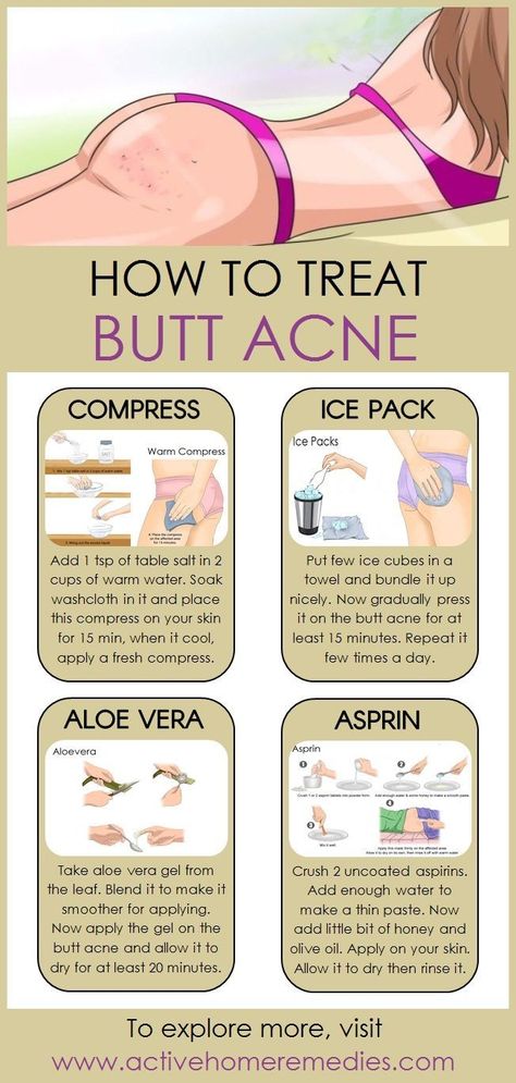 Forehead Acne, Acne Remedies, How To Get Rid Of Acne, Skin Care Remedies, Body Skin Care Routine, Diy Skin Care, Diy Skin, How To Treat Acne, Face Skin Care