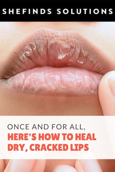 Dry Lips Remedy, Chapped Lips Remedy, Lip Healing, Lip Care Tips, Dry Cracked Lips, What Is Health, Lip Care Routine, Skin Natural Remedies, Health Signs